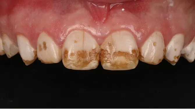 Цельнокерамические коронки на передние зубы при флюорозе
